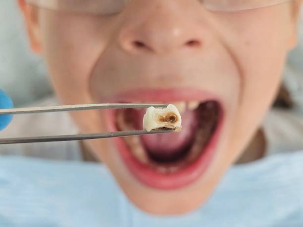 Best Dentist for Tooth Abscess  in Cuba, MO